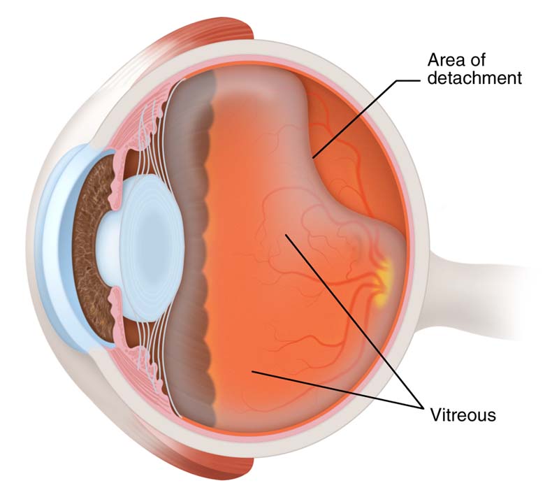 What is Posterior vitreous detachment? - Jaheed Khan