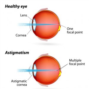 Astigmatism