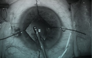 Stretching in cataract | Clinica London | Moorfields Eye Hospital