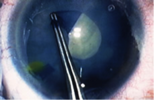 Trypan Blue in cataract surgery