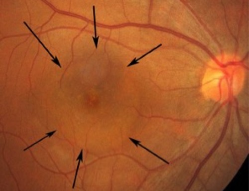 What is central serous retinopathy?